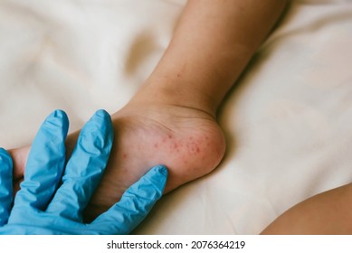 Rash of enterovirus infection picornavirus families on the feet of a 3-year-old child. Medicine, health concept - Shutterstock ID 2076364219