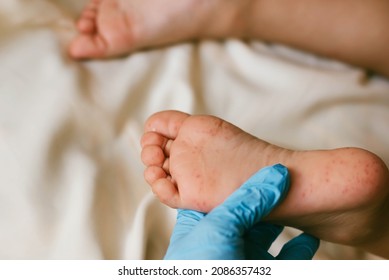 Rash of enterovirus infection picornavirus families on the feet of a 3-year-old child. Medicine, health concept - Shutterstock ID 2086357432