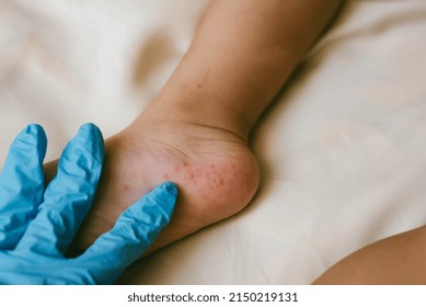Rash of enterovirus infection picornavirus families on the feet of a 3-year-old child. Medicine, health concept - Shutterstock ID 2150219131