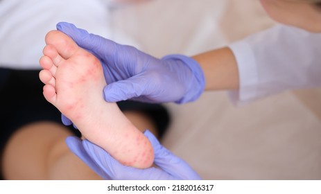 Rash With Enterovirus Infection Of Picornavirus Family On Feet Of Child