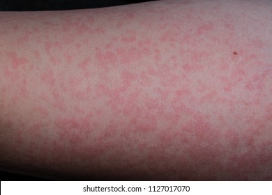 The Rash From Fifth Disease On A Child.