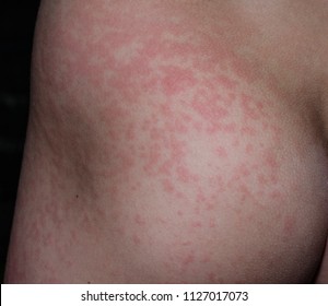 The Rash From Fifth Disease On A Child.