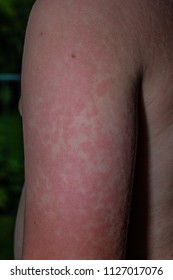 The Rash From Fifth Disease On A Child.