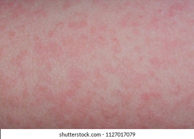 The Rash From Fifth Disease On A Child.