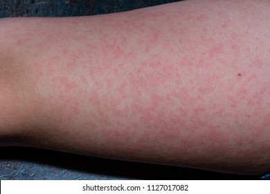 The Rash From Fifth Disease On A Child.