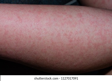 The Rash From Fifth Disease On A Child.