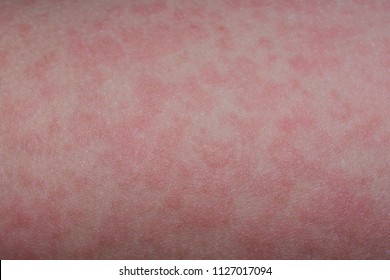 The Rash From Fifth Disease On A Child.