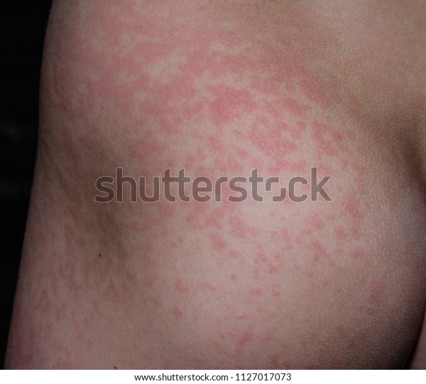 Fifth Disease Rash On Arms