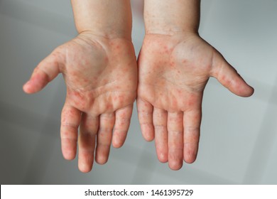 Rash on the body of a child Cocksackie virus