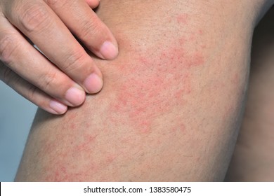 rash on the woman leg skin