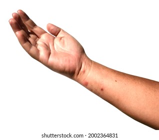 Rashes And Red Blisters On The Skin Of Human Arm And Hand Islated On White Background, Irritation From Insect Venom, The Rash And Bumps Is Caused By Allergies And Virus