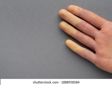 Raynaud's Disease (syndrome). Hands Of A Young Woman Suffering From Raynaud's Phenomenon. Female Fingers Turning White And Red Due To Cold Or Stress. Rheumatology
Copy Space. Top View. Grey Background