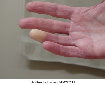 Raynaud's Syndrome Phenomenon