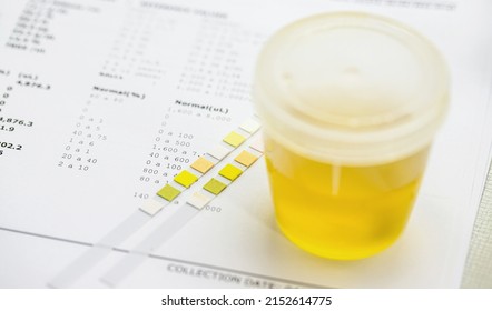 Reagent strip used for urinalysis with a vial of collected Urine, type EAS, Abnormal Sediment Elements.