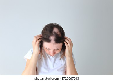 Real Alopecia Areata In A Young Girl. A Bald Head In A Person. Diffuse Alopecia. Androgenic Alopecia. Hair Loss. Bald Spots On The Head. Trichology