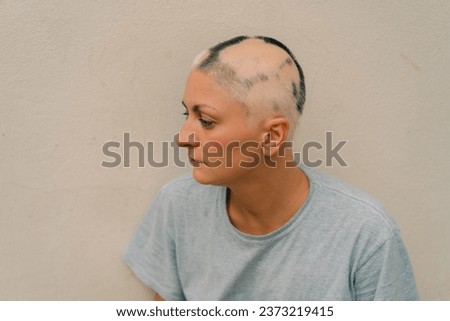 Real alopecia areata in a young girl. A bald head in a person. Diffuse alopecia. Androgenic alopecia. Hair loss. Bald spots on the head. Trichology. High quality photo