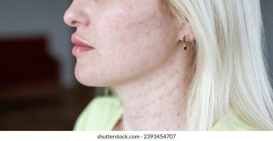Real biorevitalization of the skin on a white background. Traces of injections of biorevitalization on the face of a woman. Traces of biorevitalization needles.