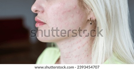 Real biorevitalization of the skin on a white background. Traces of injections of biorevitalization on the face of a woman. Traces of biorevitalization needles.