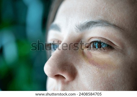 Real bruise hematoma under eye of sad young woman suffered from domestic violence. Close-up part of female victim injured face. Abuse, tyranny, human cruelty intimidation, physical violence concept.