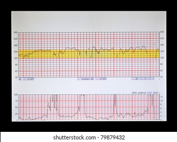 A Real Fetal Heart And Uterine Contraction Strip Physicians And Nurses Use To Monitor Labor Before Birth.