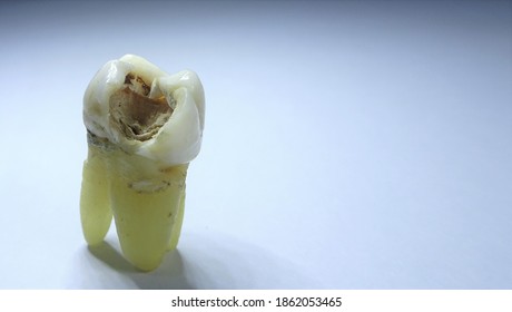 Real Human Maxillary First Molar With Untreated Caries Lesion On Occlusal Surface