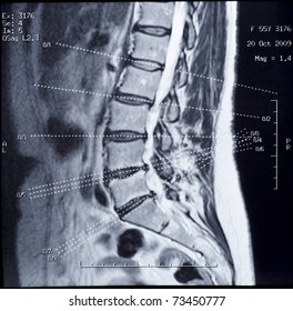 Real MRI Scan Of Human Spine, Patient's Data Cloned Out