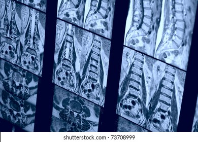 Real MRI Scan Of Human Spine