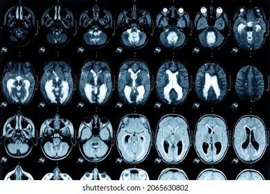Real MRI scans of the head and brain. Magnetic resonance image scan of the brain showed obstructive triventricular hydrocephalus. Background on theme of science, medicine, neurology. - Shutterstock ID 2065630802