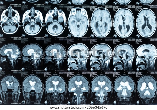 Real\
MRI scans of the head and brain. Magnetic resonance image scan of\
the brain showed obstructive triventricular hydrocephalus.\
Background on theme of science, medicine,\
neurology.