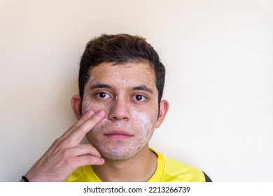 Real Photo Of A Young Man Applying A Medical Treatment To Eliminate Acne With His Two Fingers On His Face. His Eyes Are Open And His View Is Straight Ahead. Wears A Yellow T-shirt