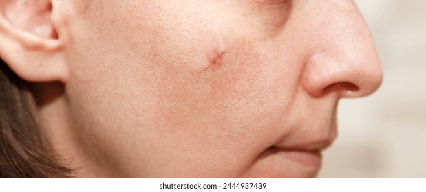 Real scar on the young woman face, scar on the cheek after a mole removal surgery. Scar after plastic surgery