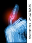 Real X-ray scan - broken finger side view. Pinky finger phalanx displace fracture. Radiology diagnosis.