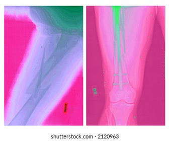 Real X-rays Of A Femur Fracture, Colorized To Render The Anatomy Better. This Man Broke His Leg In A Motorcycle Accident. A Super Before And After Story.