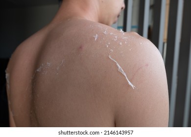 Rear Or Back View Of Caucasian Man Got A Painful Sunburn. Sunburnt At The Back And Shoulder Of White Skin Man. Skin Start To Recover From Sunburn In The Summer. Rotten Skin And Unhealth Concept.