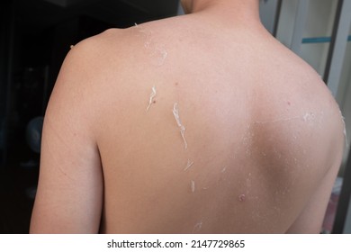 Rear Or Back View Of Caucasian Man Got A Painful Sunburn. Sunburnt At The Back And Shoulder Of White Skin Man. Skin Start To Recover From Sunburn In The Summer. Rotten Skin And Unhealth Concept.