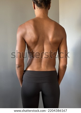 Rear view of a Black person back showing the curvature of their spine due to scoliosis