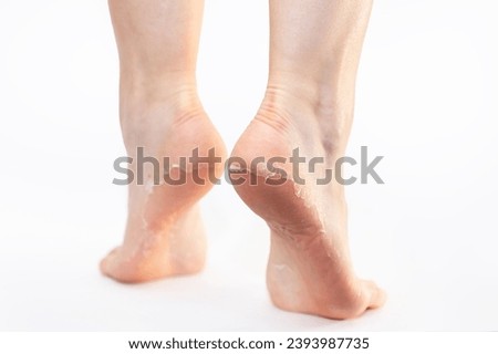 Rear view of female feet with peeling skin on heels, on white background. Skin care and peeling leg's soles.