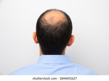 Rear view of a male head with thinning hair or alopecia