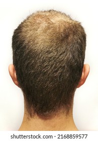 Rear View Of A Male Head Without Hair On Scalp Isolated On White Background. Hair Loss Concept, Bird's Nest On The Head. Problems With Hair Regrowth,  Androgenic Alopecia. Vertical Photo