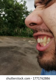 Receding Gums On Left Canine Tooth, Lateral Incisor And Upper Left First Molar. 