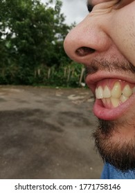 Receding Gums. Upper Left Canine, First Molar Anf Lateral Incisor. 