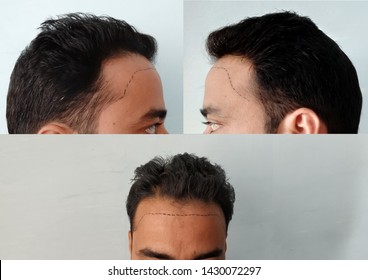 Types Baldness Stock Photos Images Photography Shutterstock