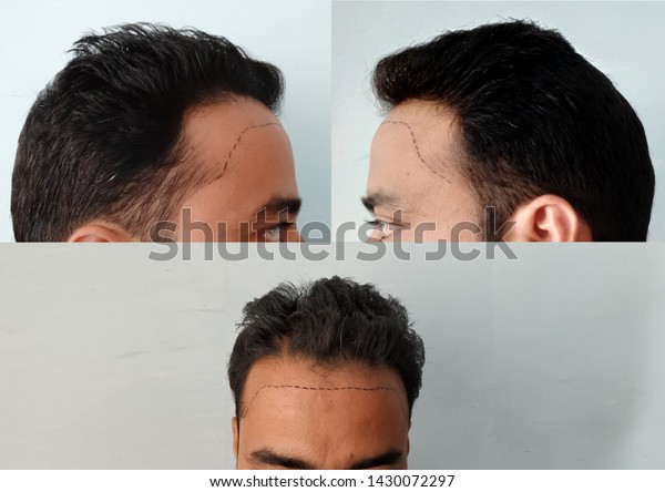 Receding Hairline Becoming Major Problem Men Stock Photo Edit Now