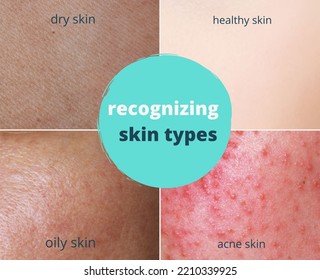 Recognizing  Skin Types , Healthy  ,dry ,oily 
 ,acne 