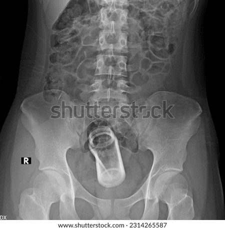 Rectal foreign bodies Foreign object in rectum