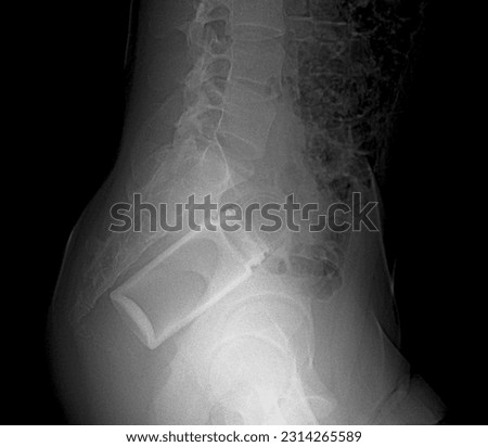 Rectal foreign bodies Foreign object in rectum