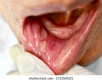 Recurrent aphthous ulcers or canker sores in inner cheek of Southeast Asian elderly man. Oval shaped ulcers in oral cavity due to sharp tooth irritation. Closeup view. - Shutterstock ID 1713569221