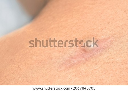 Recurring Sebaceous Cyst (Epidermoid Cysts) at the surgical wound on woman's shoulder blade. cysts form on the skin is due to clogged sebaceous glands or irritation to a hair follicle. 