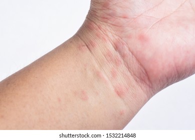 Wrist Dermatitis Hd Stock Images Shutterstock