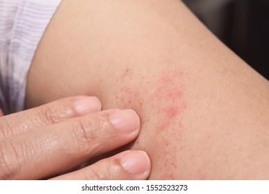 Red Allergic Rash On The Arm Skin From Atopic Dermatitis